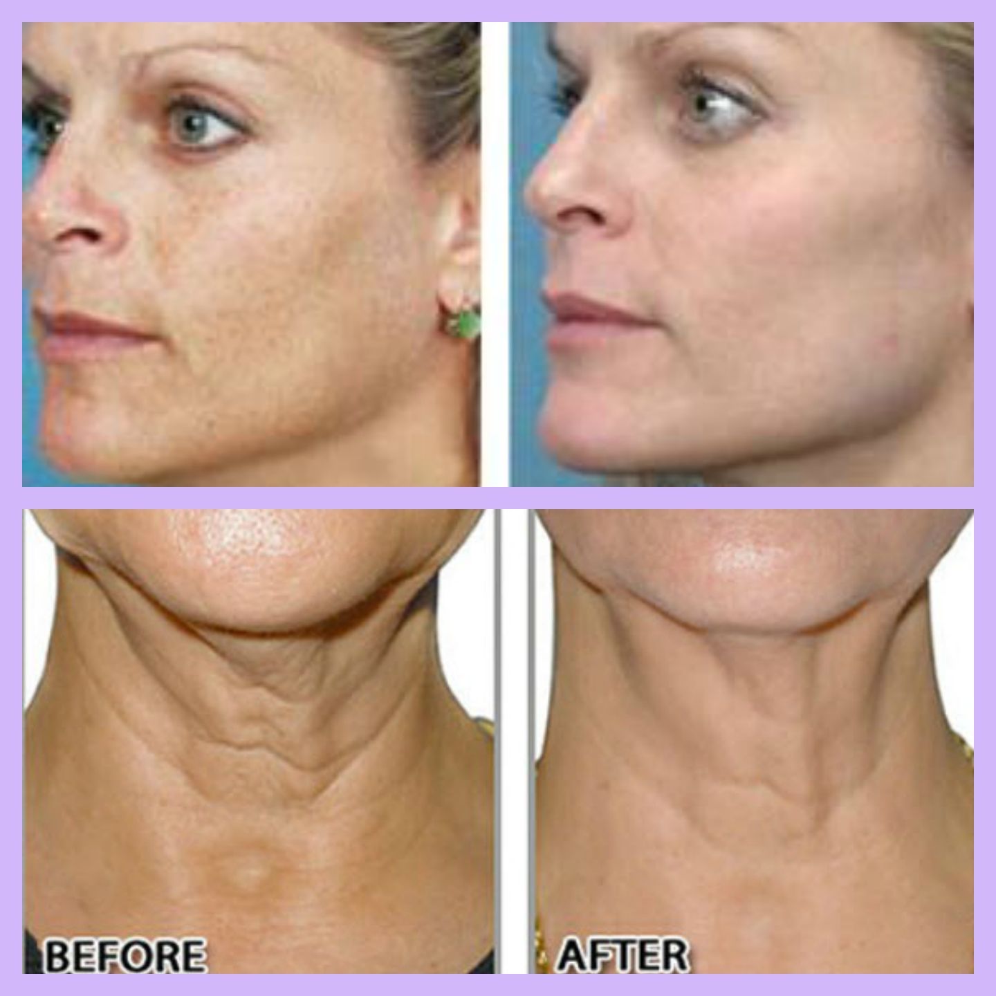 Nono Micro Cellular PPT Infusionderm 1500 Shots