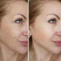 Lift Q - 無創超聲:全臉