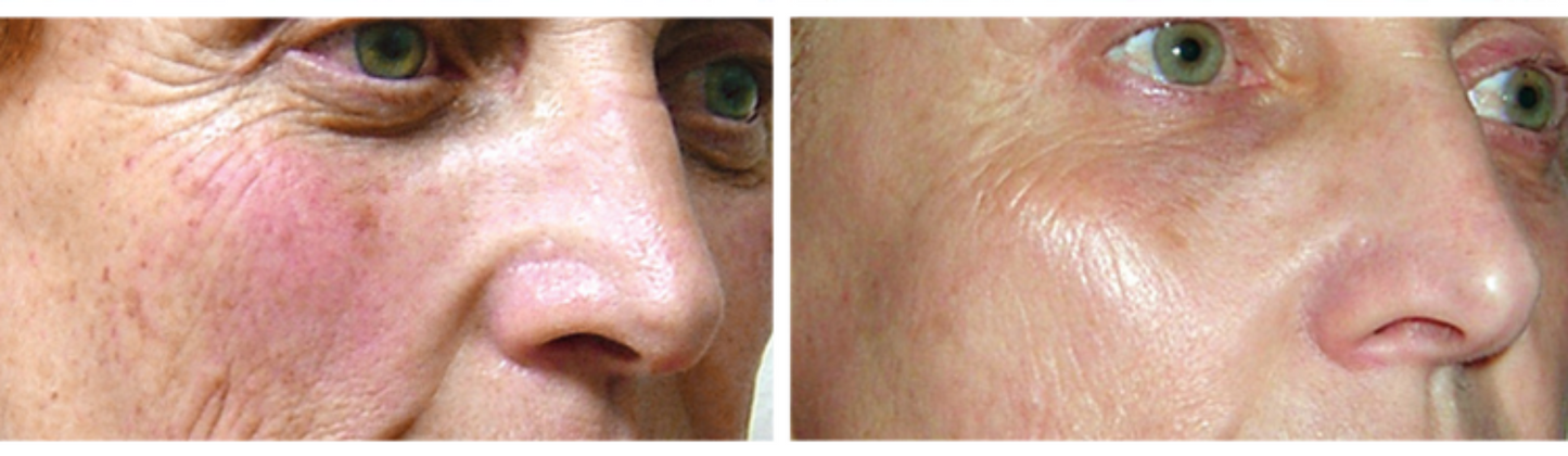 Lift Q - Non Invasive Ultrasound: Eye and Forehead/Neck