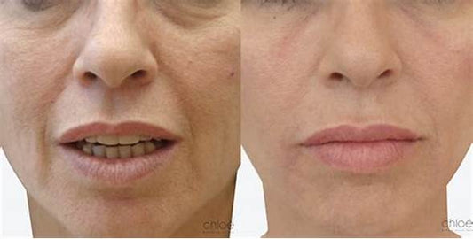 Lift Q - 無創超聲:全臉和頸部