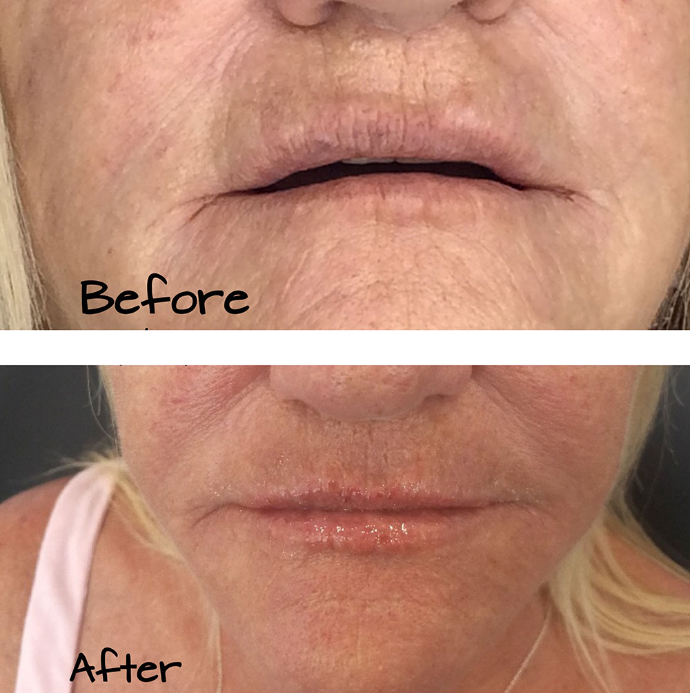 Plasma Lifting Treatment
