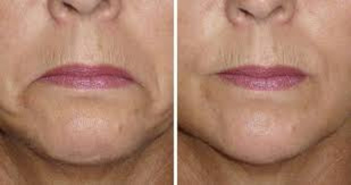 Lift Q - Non Invasive Ultrasound: V Shape/Double Chin