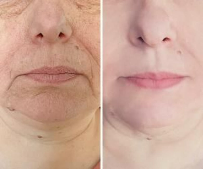 Lift Q - Non Invasive Ultrasound: Full Face and Neck