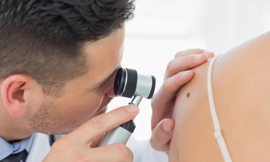 Permanent Electrolysis Wart Removal