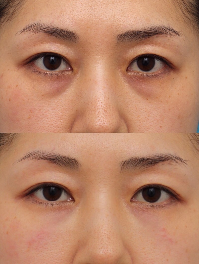 LRB Golden Ionic Rejuvenating Eye Treatment + Eye Spa Treatment