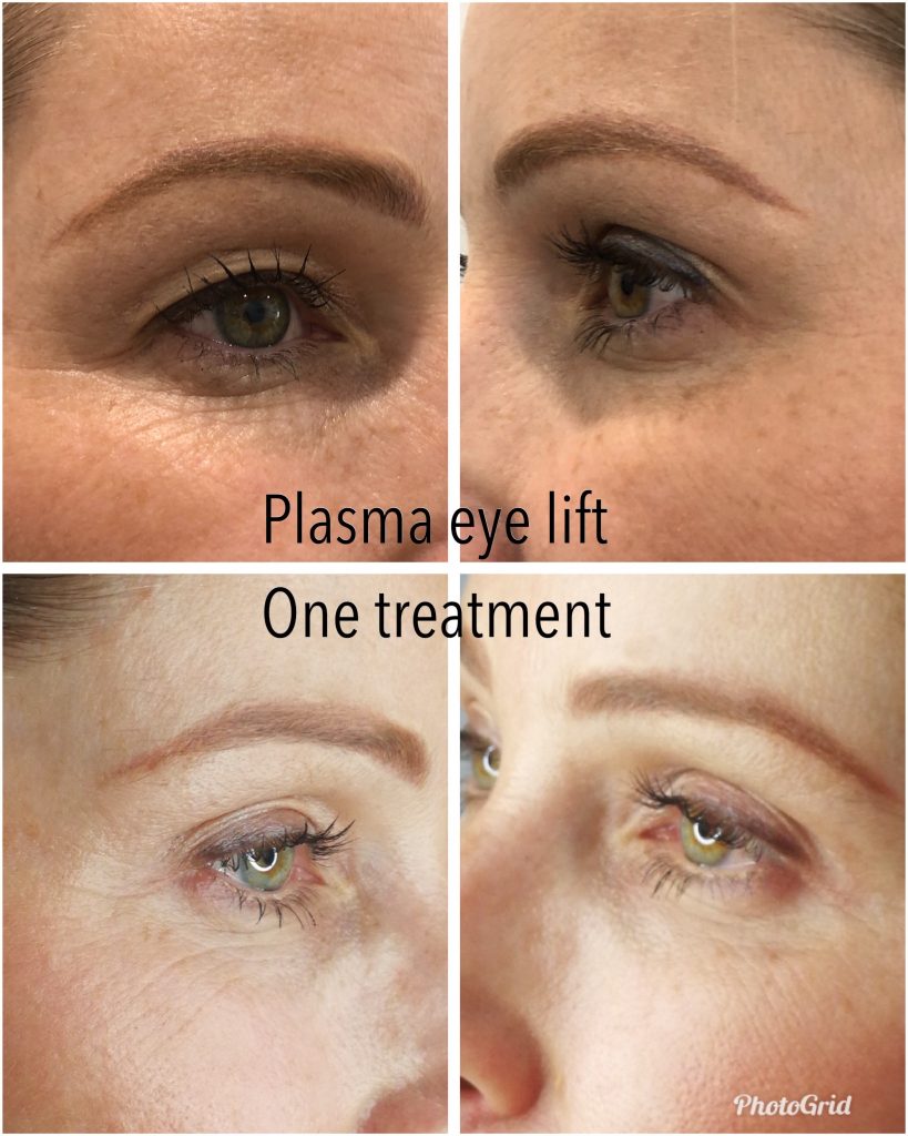 Plasma Lifting Eye Treatment